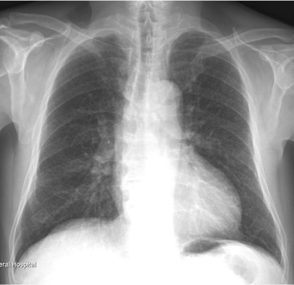 TB Radiology Image Library